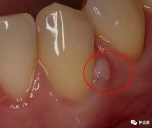 牙齦上長膿包，擠掉后還反復(fù)長出，怎么回事？