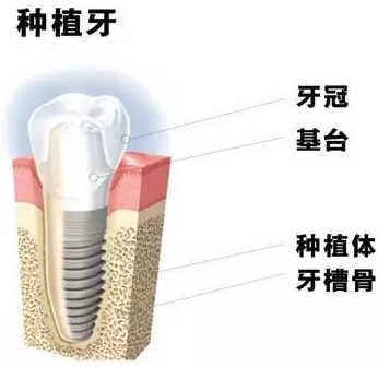 種植牙會松動的原因是什么？