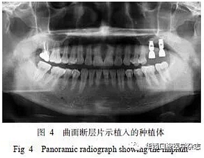 利用壓膜式活動矯治器壓入下頜第一、第二磨牙1例