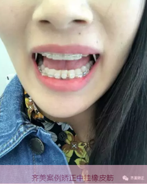 牙齒矯正，為什么要掛橡皮筋？