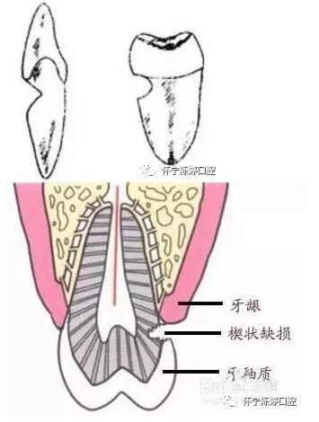 什么是牙齒楔缺？