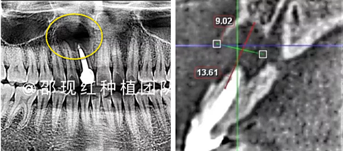 「科普篇」你真的了解它嗎？——β-磷酸三鈣