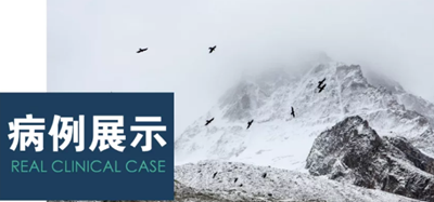 病例賞析 | 上頜竇外提升長(zhǎng)期成骨觀(guān)察