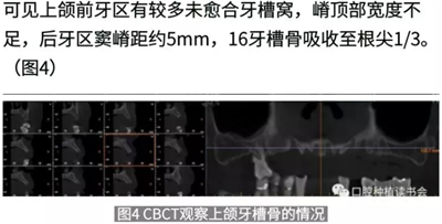 病例報(bào)道│全程數(shù)字化輔助無牙頜種植即刻負(fù)重