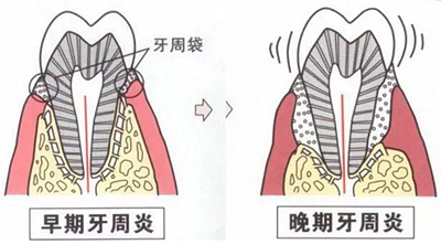 上海嘉福口腔研究所二十一世紀(jì)牙周病的臨床進(jìn)展