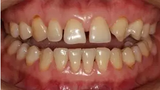 病例分享｜復(fù)合樹(shù)脂微創(chuàng)美學(xué)修復(fù)關(guān)閉上前牙間隙
