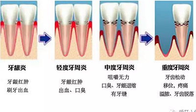 什么是牙齦萎縮？