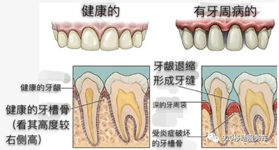 什么是牙齦萎縮？