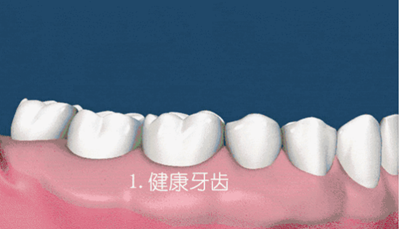 什么是牙齦萎縮？