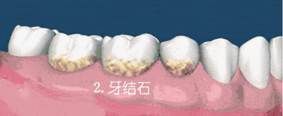 什么是牙齦萎縮？
