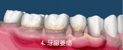 什么是牙齦萎縮？