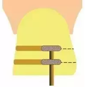 貼面?zhèn)溲乐嗌伲? alt=