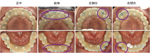 【病例分享】應(yīng)用全程數(shù)字化對(duì)牙周炎患者實(shí)現(xiàn)全口即刻種植即刻修復(fù)