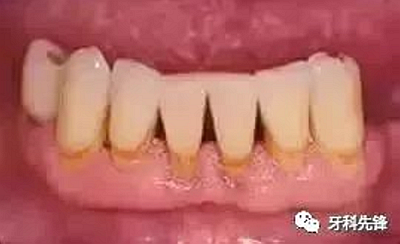 	牙齦萎縮是不治之癥？緩解牙齦萎縮5步走！