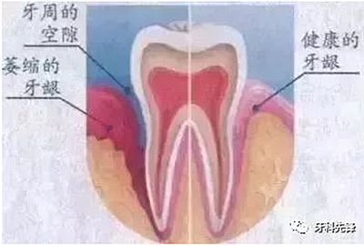 	牙齦萎縮是不治之癥？緩解牙齦萎縮5步走！