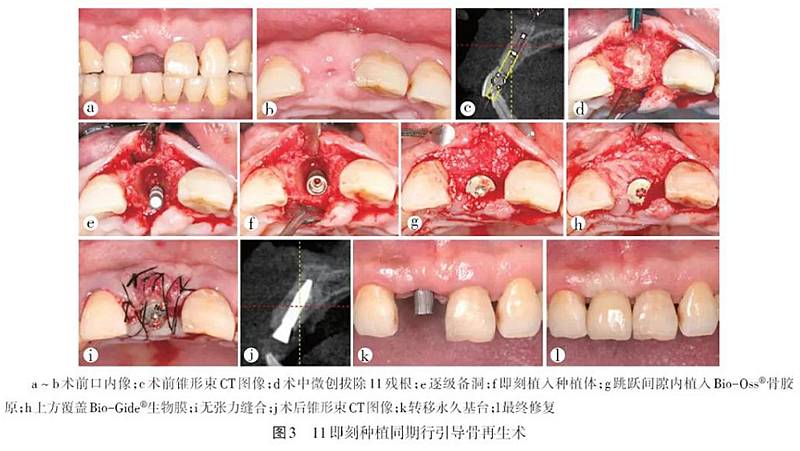 前牙美學(xué)區(qū)種植時機(jī)的選擇